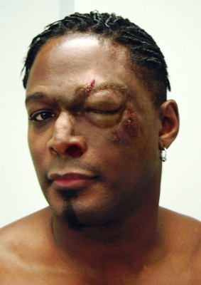 Boxer: prosthetic swelling